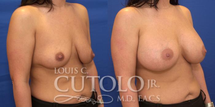 Before & After Breast Augmentation Case 182 View #4 View in Brooklyn, Staten Island, Queens, NY