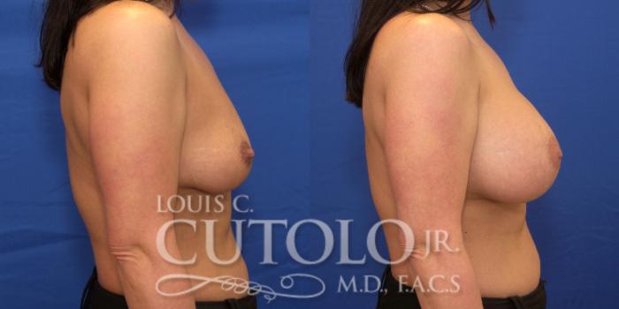 Before & After Breast Augmentation Case 182 View #5 View in Brooklyn, Staten Island, Queens, NY