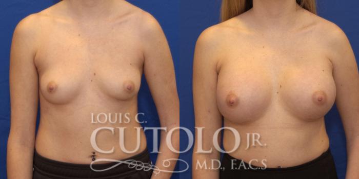 Before & After Breast Augmentation Case 187 View #1 View in Brooklyn, Staten Island, Queens, NY