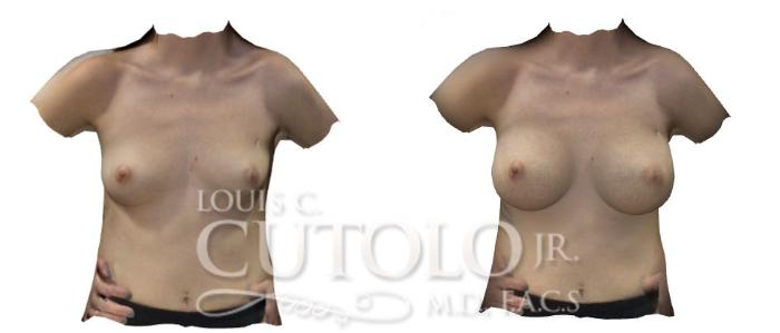 Before & After Breast Augmentation Case 187 View #2 View in Brooklyn, Staten Island, Queens, NY