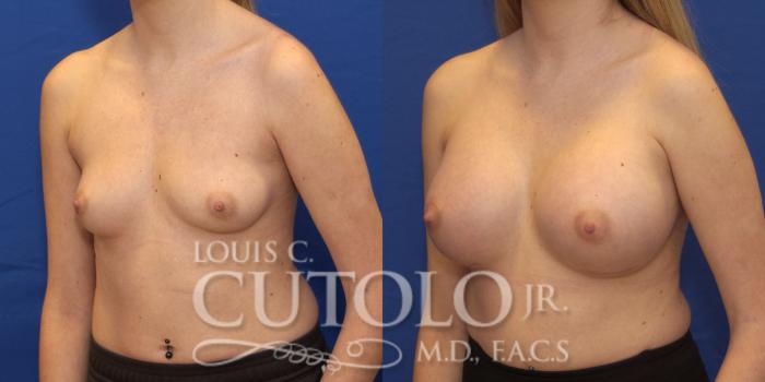 Before & After Breast Augmentation Case 187 View #3 View in Brooklyn, Staten Island, Queens, NY