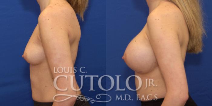 Before & After Breast Augmentation Case 187 View #4 View in Brooklyn, Staten Island, Queens, NY
