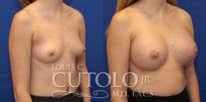 Before & After Breast Augmentation Case 187 View #5 View in Brooklyn, Staten Island, Queens, NY