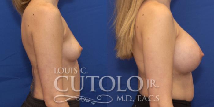 Before & After Breast Augmentation Case 187 View #6 View in Brooklyn, Staten Island, Queens, NY