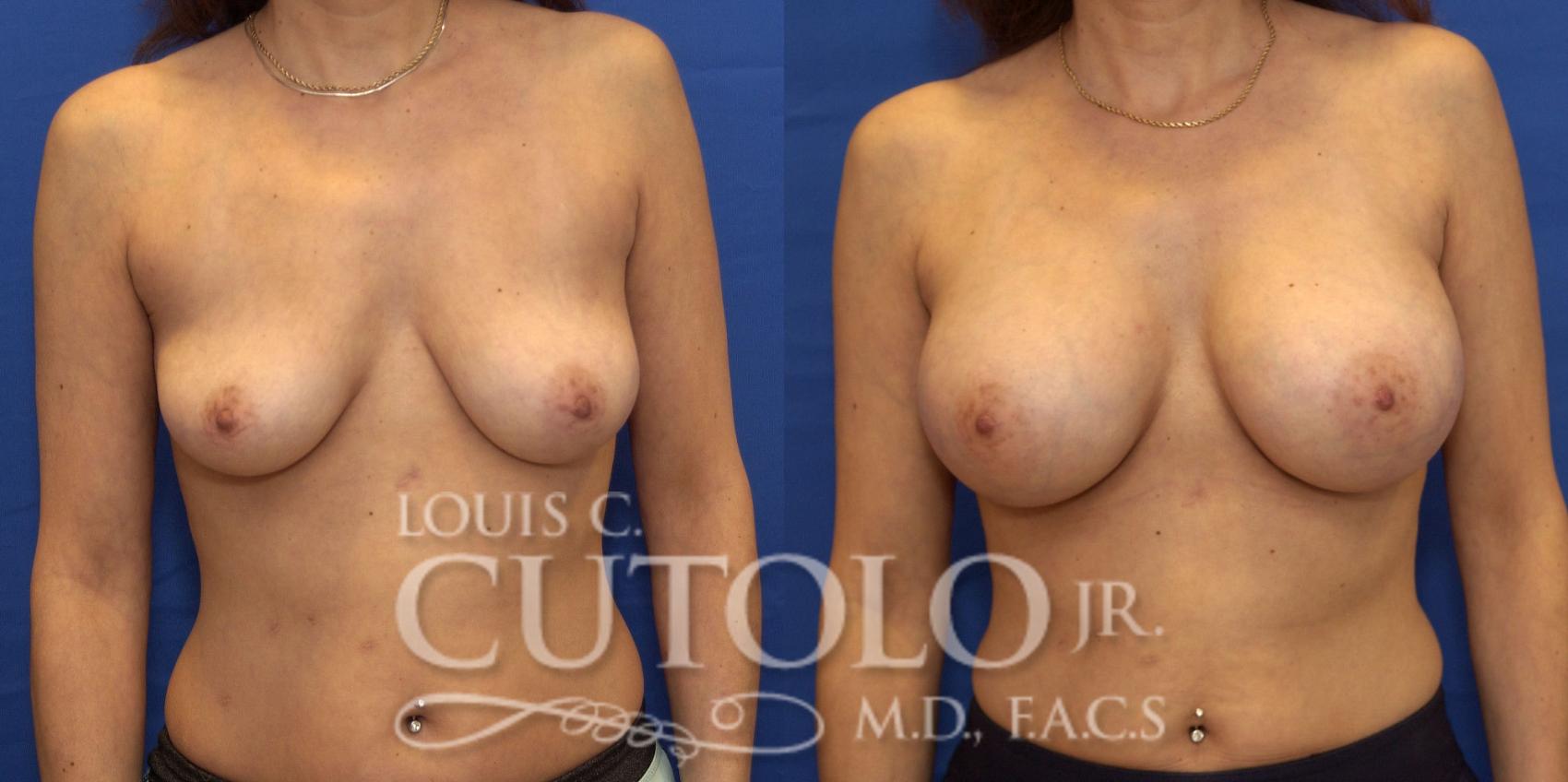 Before & After Breast Augmentation Case 188 View #1 View in Brooklyn, Staten Island, Queens, NY