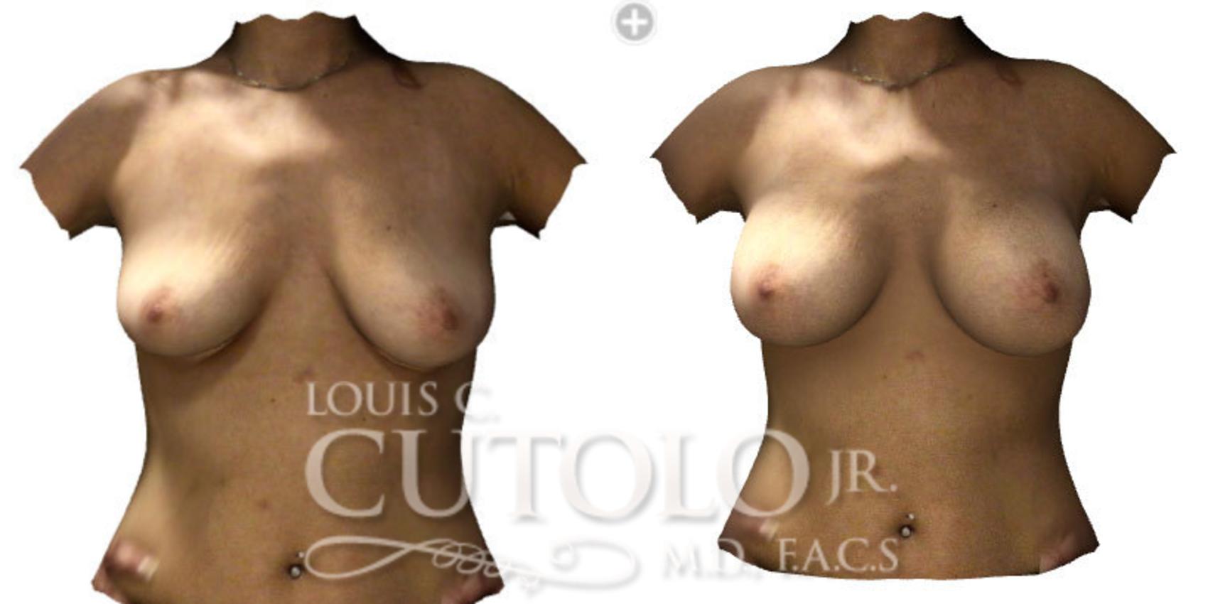 Before & After Breast Augmentation Case 188 View #2 View in Brooklyn, Staten Island, Queens, NY