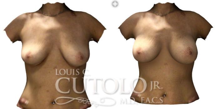 Before & After Breast Augmentation Case 188 View #2 View in Brooklyn, Staten Island, Queens, NY