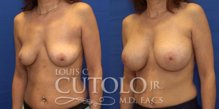 Before & After Breast Augmentation Case 188 View #3 View in Brooklyn, Staten Island, Queens, NY