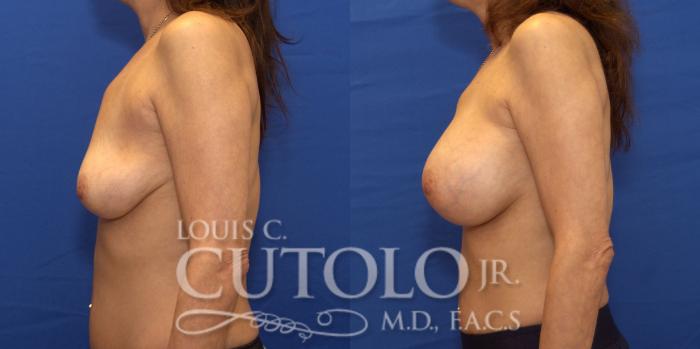 Before & After Breast Augmentation Case 188 View #4 View in Brooklyn, Staten Island, Queens, NY