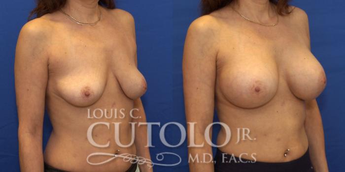 Before & After Breast Augmentation Case 188 View #5 View in Brooklyn, Staten Island, Queens, NY