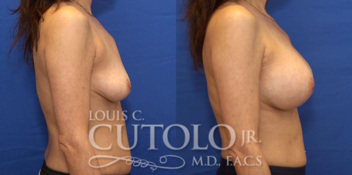 Before & After Breast Augmentation Case 188 View #6 View in Brooklyn, Staten Island, Queens, NY
