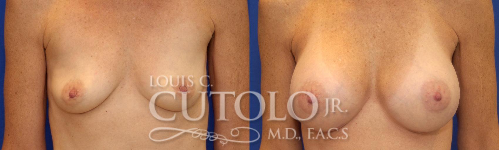 Before & After Breast Augmentation Case 19 View #1 View in Brooklyn, Staten Island, Queens, NY