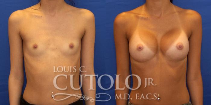 Before & After Breast Augmentation Case 190 View #1 View in Brooklyn, Staten Island, Queens, NY