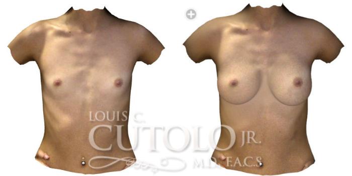 Before & After Breast Augmentation Case 190 View #2 View in Brooklyn, Staten Island, Queens, NY
