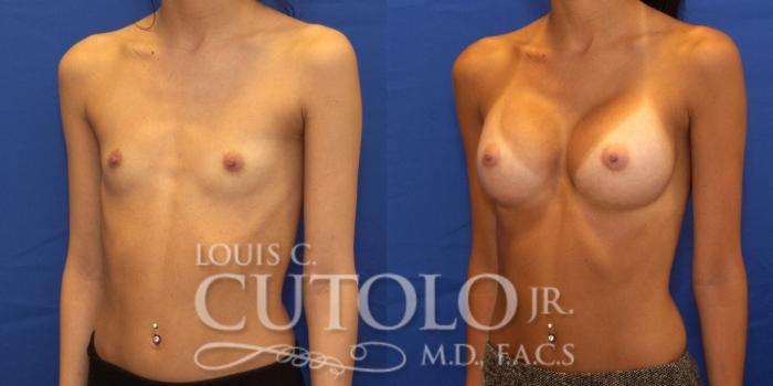 Before & After Breast Augmentation Case 190 View #3 View in Brooklyn, Staten Island, Queens, NY