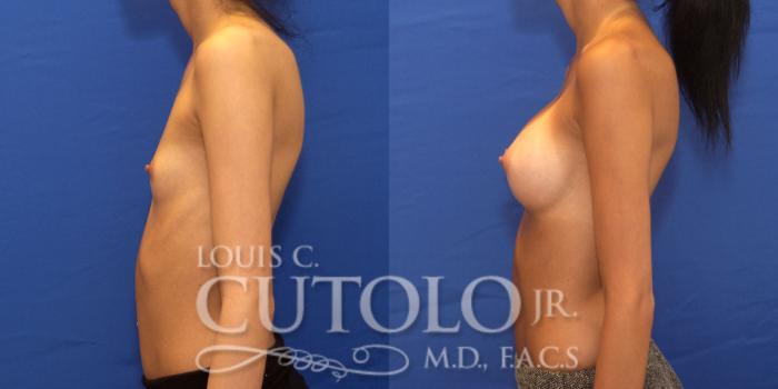 Before & After Breast Augmentation Case 190 View #4 View in Brooklyn, Staten Island, Queens, NY