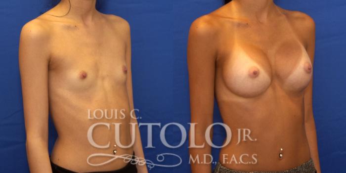 Before & After Breast Augmentation Case 190 View #5 View in Brooklyn, Staten Island, Queens, NY