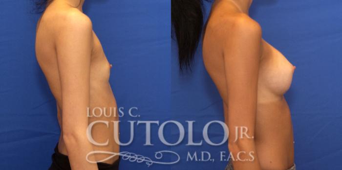 Before & After Breast Augmentation Case 190 View #6 View in Brooklyn, Staten Island, Queens, NY