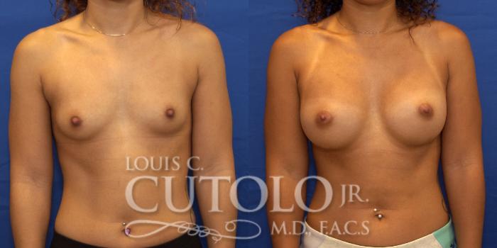 Before & After Breast Augmentation Case 191 View #1 View in Brooklyn, Staten Island, Queens, NY