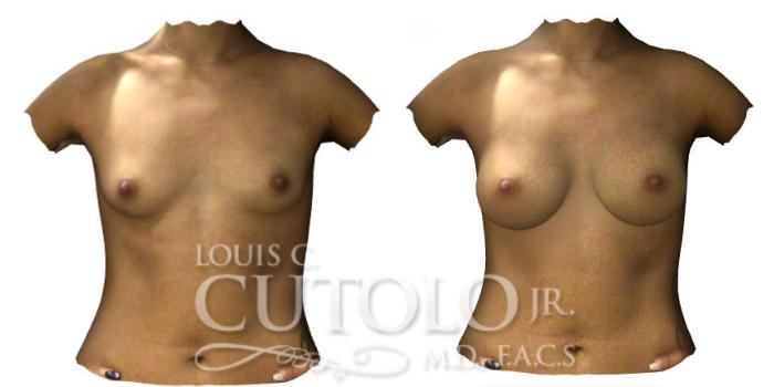 Before & After Breast Augmentation Case 191 View #2 View in Brooklyn, Staten Island, Queens, NY