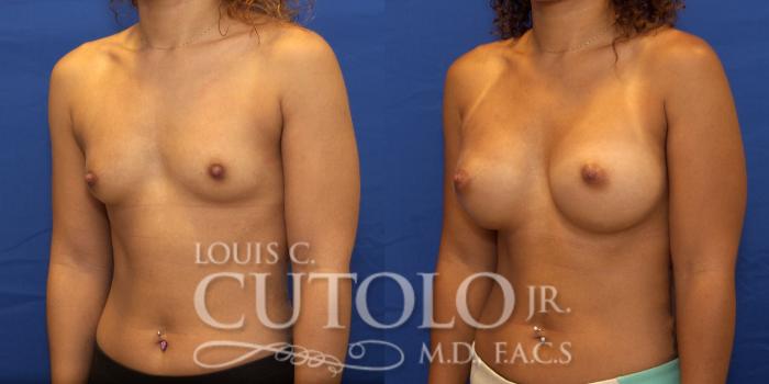Before & After Breast Augmentation Case 191 View #3 View in Brooklyn, Staten Island, Queens, NY