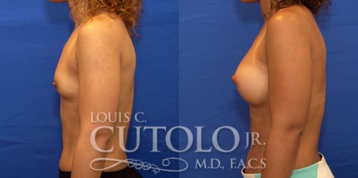 Before & After Breast Augmentation Case 191 View #4 View in Brooklyn, Staten Island, Queens, NY