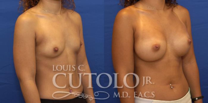 Before & After Breast Augmentation Case 191 View #5 View in Brooklyn, Staten Island, Queens, NY