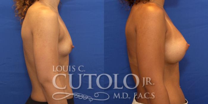 Before & After Breast Augmentation Case 191 View #6 View in Brooklyn, Staten Island, Queens, NY