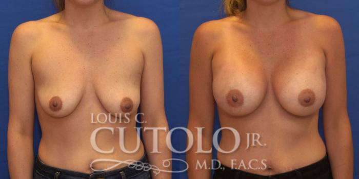 Before & After Breast Augmentation Case 192 View #1 View in Brooklyn, Staten Island, Queens, NY