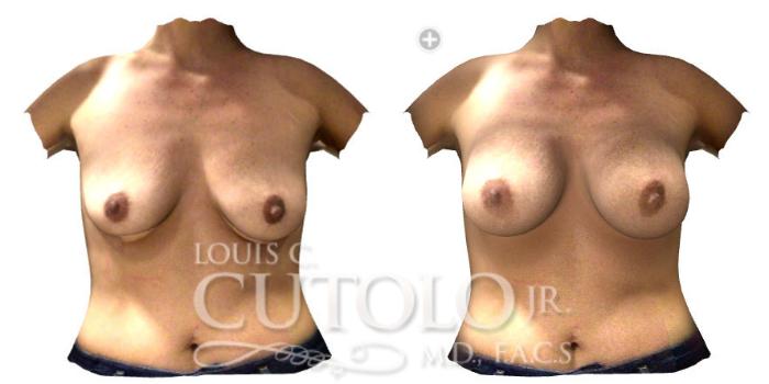 Before & After Breast Augmentation Case 192 View #2 View in Brooklyn, Staten Island, Queens, NY