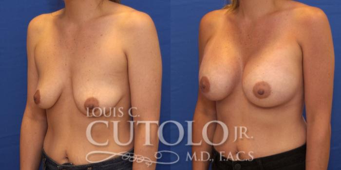 Before & After Breast Augmentation Case 192 View #3 View in Brooklyn, Staten Island, Queens, NY