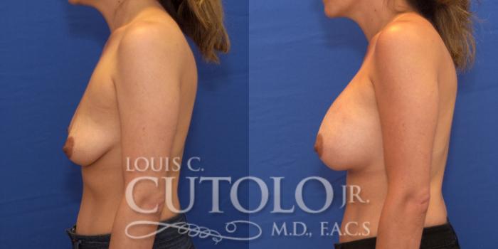 Before & After Breast Augmentation Case 192 View #4 View in Brooklyn, Staten Island, Queens, NY