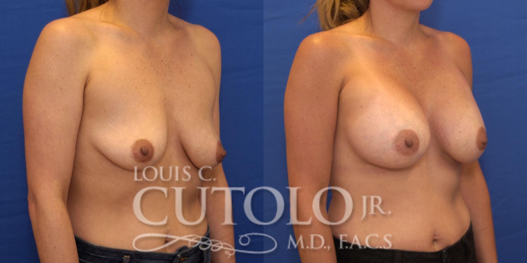 Before & After Breast Augmentation Case 192 View #5 View in Brooklyn, Staten Island, Queens, NY