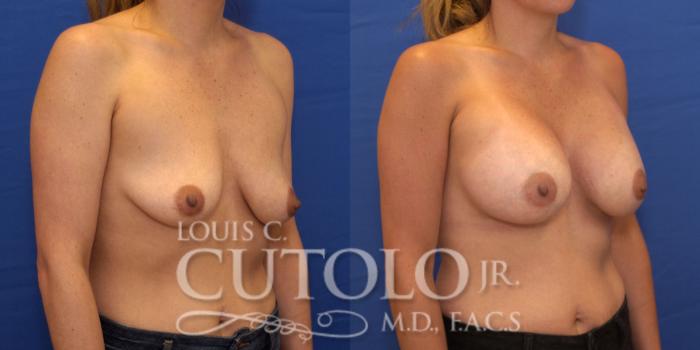 Before & After Breast Augmentation Case 192 View #5 View in Brooklyn, Staten Island, Queens, NY