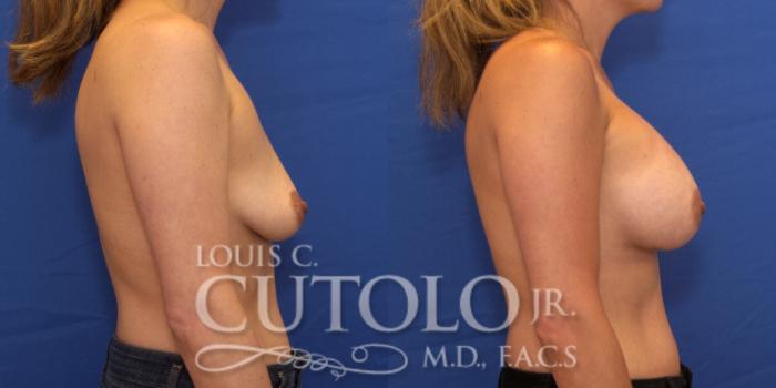 Before & After Breast Augmentation Case 192 View #6 View in Brooklyn, Staten Island, Queens, NY
