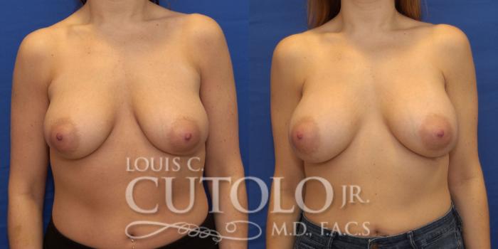 Before & After Breast Augmentation Case 194 View #1 View in Brooklyn, Staten Island, Queens, NY