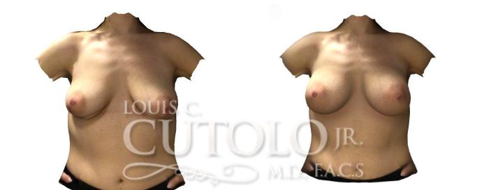 Before & After Breast Augmentation Case 194 View #2 View in Brooklyn, Staten Island, Queens, NY