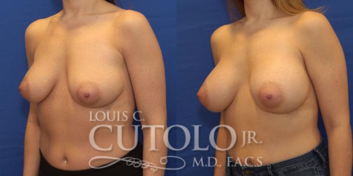 Before & After Breast Augmentation Case 194 View #3 View in Brooklyn, Staten Island, Queens, NY