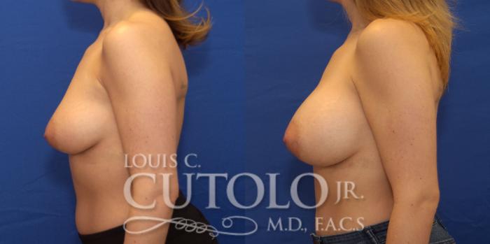 Before & After Breast Augmentation Case 194 View #4 View in Brooklyn, Staten Island, Queens, NY
