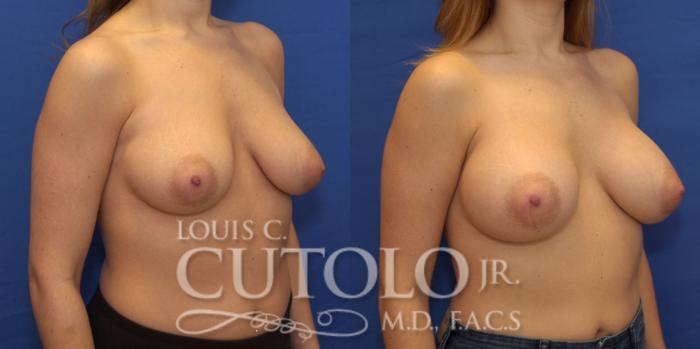 Before & After Breast Augmentation Case 194 View #5 View in Brooklyn, Staten Island, Queens, NY