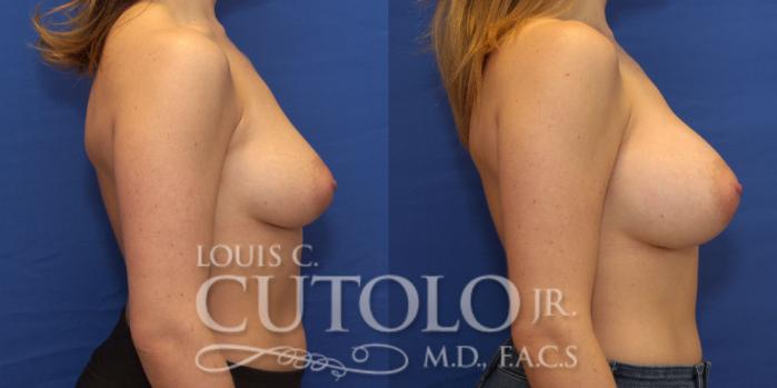 Before & After Breast Augmentation Case 194 View #6 View in Brooklyn, Staten Island, Queens, NY