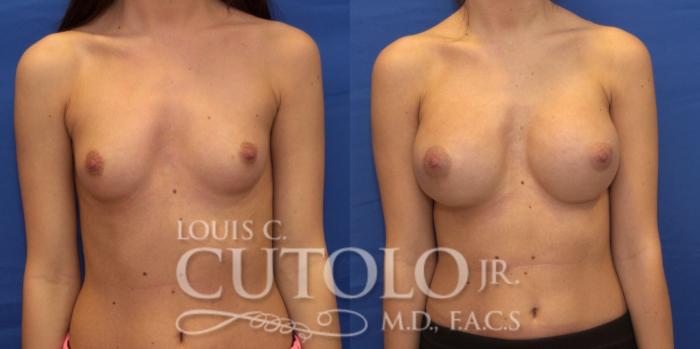 Before & After Breast Augmentation Case 196 View #1 View in Brooklyn, Staten Island, Queens, NY