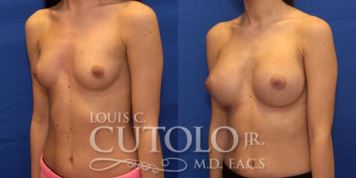 Before & After Breast Augmentation Case 196 View #2 View in Brooklyn, Staten Island, Queens, NY