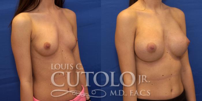 Before & After Breast Augmentation Case 196 View #4 View in Brooklyn, Staten Island, Queens, NY