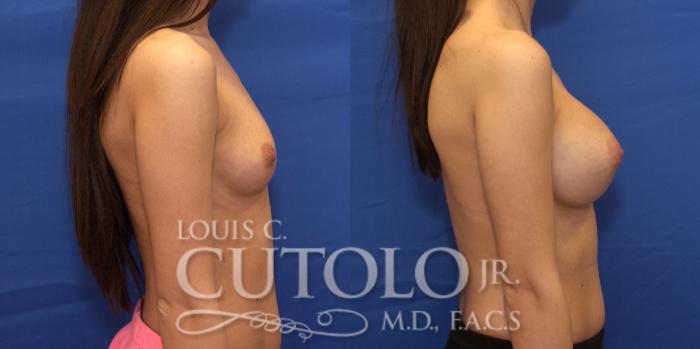 Before & After Breast Augmentation Case 196 View #5 View in Brooklyn, Staten Island, Queens, NY