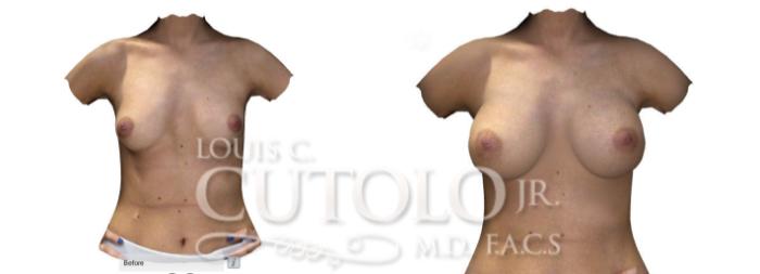 Before & After Breast Augmentation Case 196 View #6 View in Brooklyn, Staten Island, Queens, NY