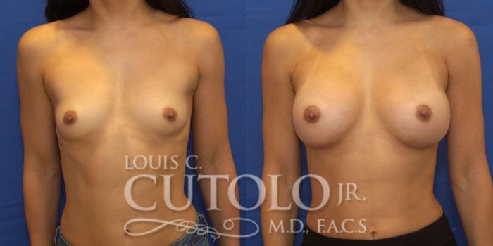 Before & After Breast Augmentation Case 199 View #1 View in Brooklyn, Staten Island, Queens, NY