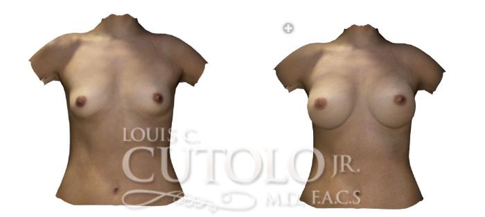 Before & After Breast Augmentation Case 199 View #2 View in Brooklyn, Staten Island, Queens, NY