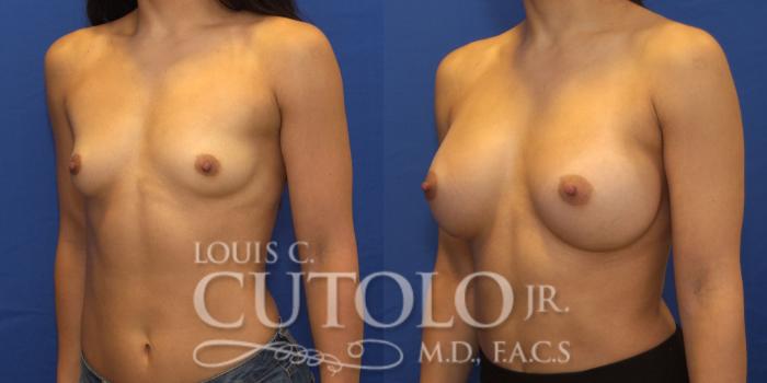 Before & After Breast Augmentation Case 199 View #3 View in Brooklyn, Staten Island, Queens, NY