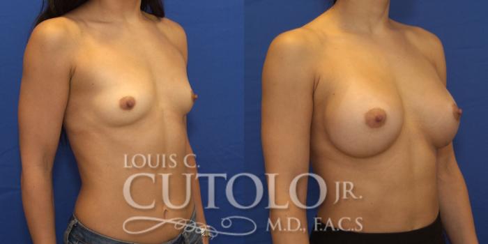 Before & After Breast Augmentation Case 199 View #5 View in Brooklyn, Staten Island, Queens, NY
